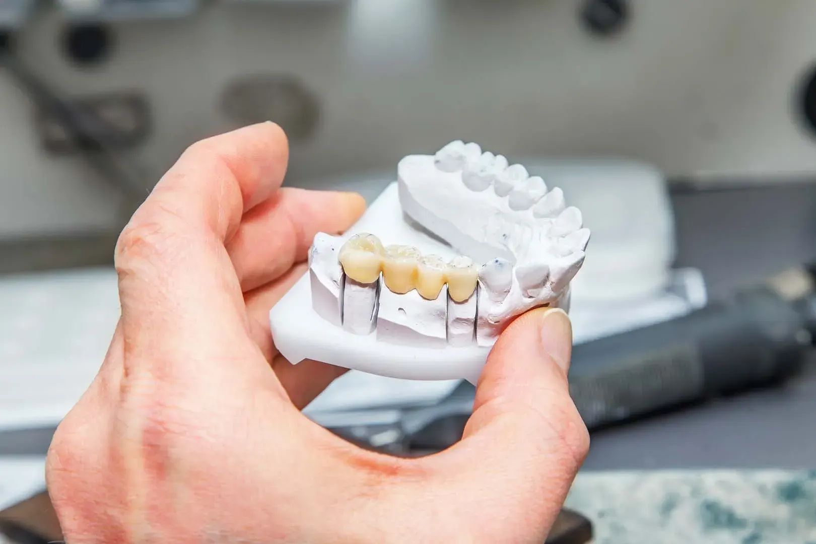 Bridges at Clark Dental in Salisbury, NC