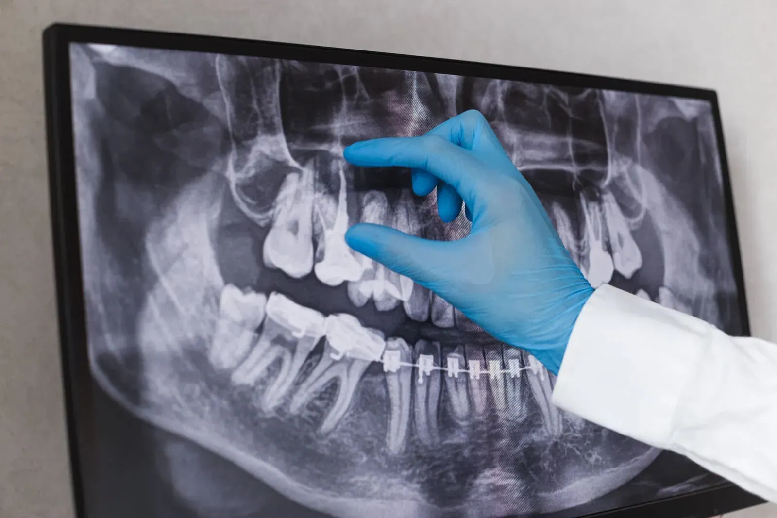 Endodontics at Clark Dental in Salisbury, NC